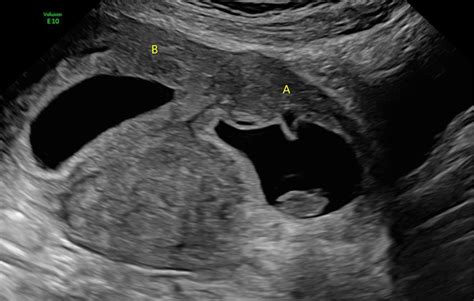 Surgical Management Of First‐trimester Heterotopic Dichorionic