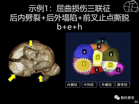 胫骨平台骨折四柱九区分型理论介绍 MedSci cn