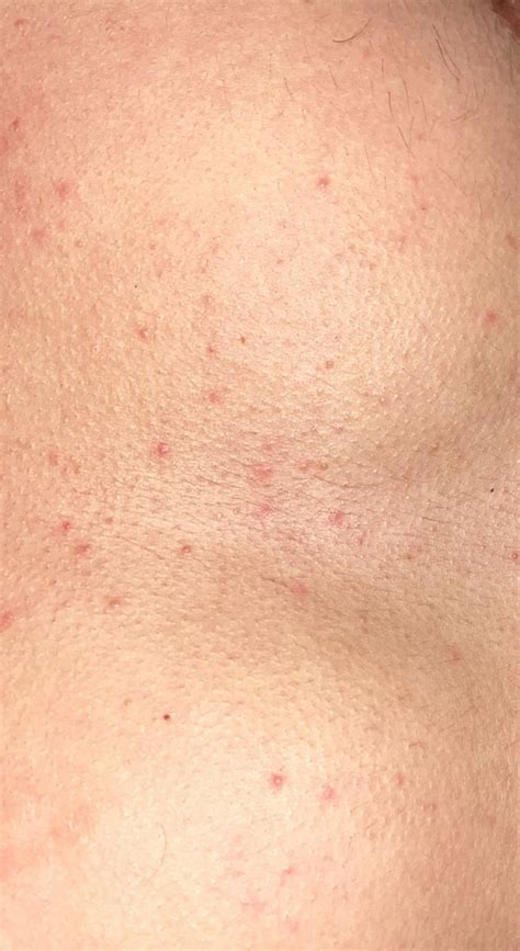 Does This Look Like A Hiv Rash Rhiv