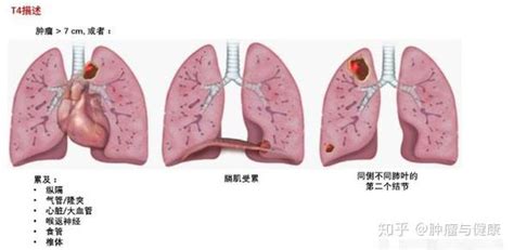 肺癌的真正的分期和治疗，看懂这些知识，再也不花一分冤枉钱 知乎