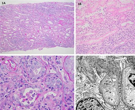 Kidney Biopsy Showed Acute Tubulointerstitial Nephritis A B A