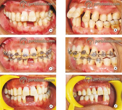 Orthodontic Periodontal Interrelationship