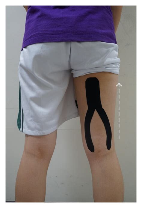 Effects Of Kinesio Taping Versus Mcconnell Taping For Patellofemoral