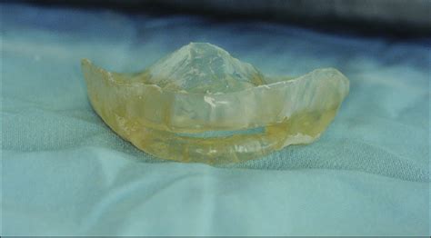 Custom Made Mono Block Oral Appliance Download Scientific Diagram