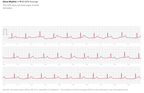 The Apple Watch ECG feature is now here. This is what you need to know.