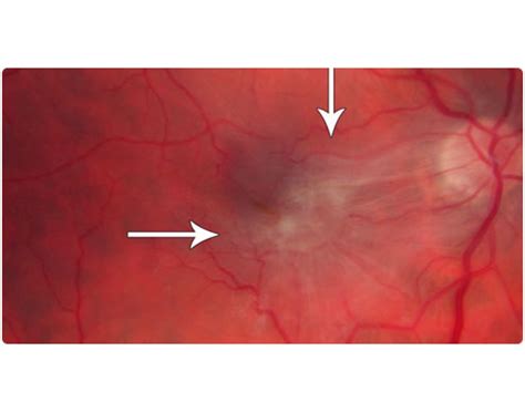 Macular Pucker | Southern Vitreoretinal Associates