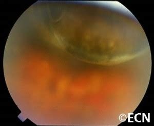 Choroidal Melanoma New York Eye Cancer Center