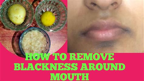 How To Remove Blackness Around Mouthpermanent Solutionblack Patches