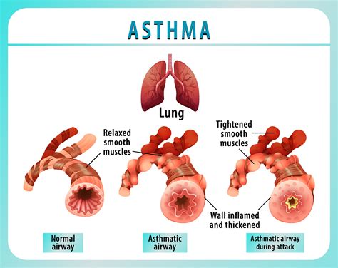 Bronchial Asthma diagram with normal airway and asthmatic airway ...