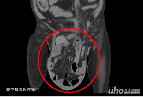 疝氣拖10年 陰囊腫成18公分大 Uho優活健康網