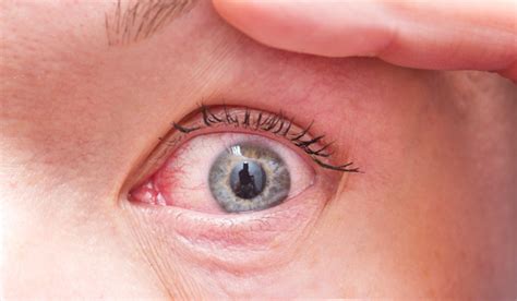 Picor De Ojos Conoce Las Causas Tratamiento Y Prevenci N