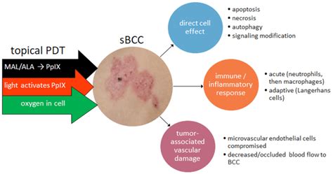 Effects of topical photodynamic therapy on superficial BCC (sBCC) (MAL,... | Download Scientific ...