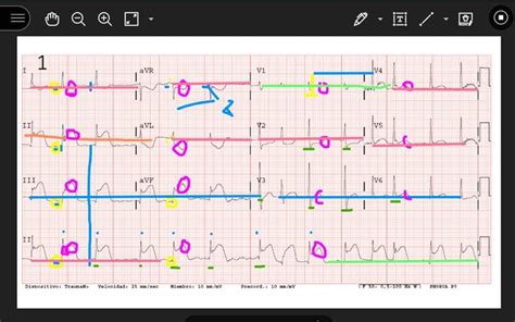 Electrocardiografía Clínica Para Enfermería Centro De Simulación Clínica