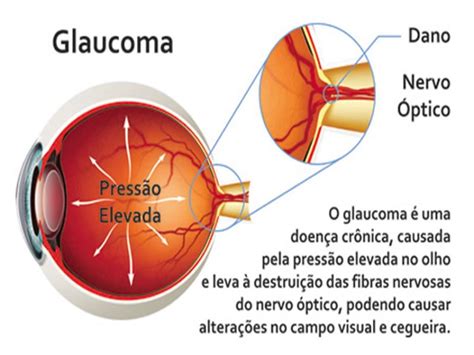 Saiba Alguns Hábitos Que Podem Agravar O Glaucoma Centro