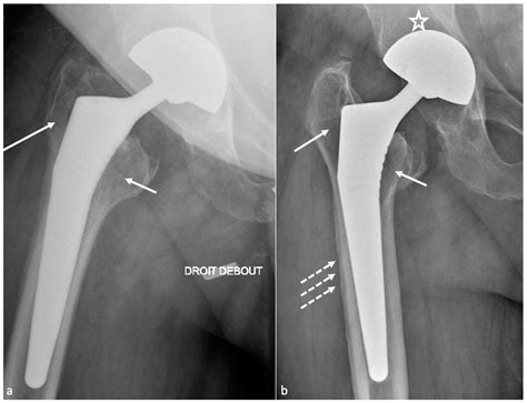 Imaging In Hip Arthroplasty Management Part Postoperative Diagnostic