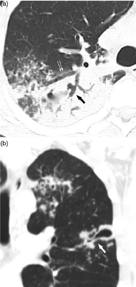 A 34-year-old man with active TB. (a) Axial CT scans show an irregular ...