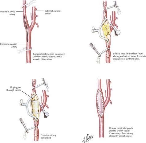 Exposure Of The Carotid Bifurcation Basicmedical Key