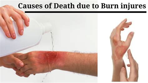 Burn Injury Thermal Injury Youtube