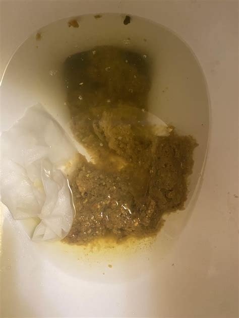 Is this normal? Does it look like c diff? : r/poop