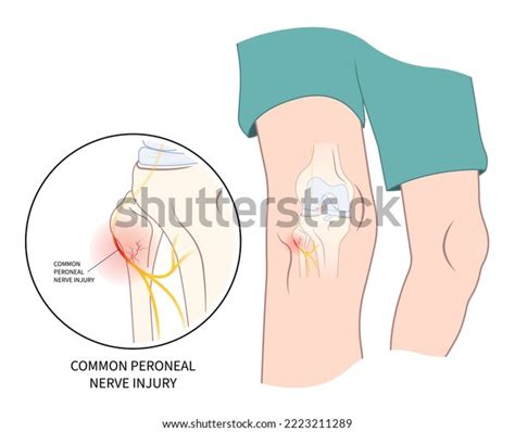 Cervical Spinal Cord Test Pain Trauma Stock Vector (Royalty Free ...