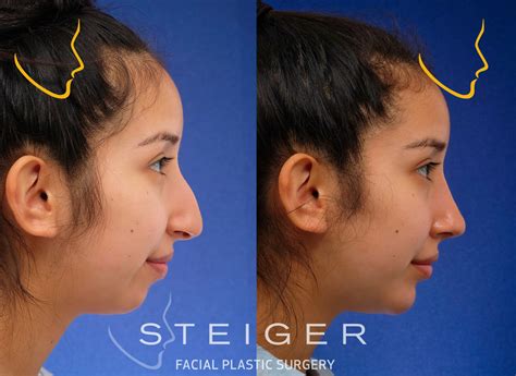 Rhinoplasty Before And After Photos