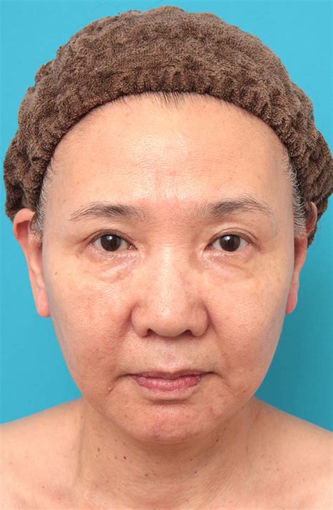 【症例写真】フルフェイスリフトを行った60代女性の症例：美容外科 高須クリニック