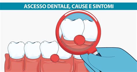 Ascesso Dentale Cause E Sintomi Studio Dentistico Michelangelo