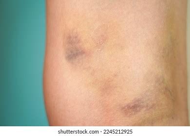 Large Hematoma On Leg Below Knee Stock Photo Shutterstock