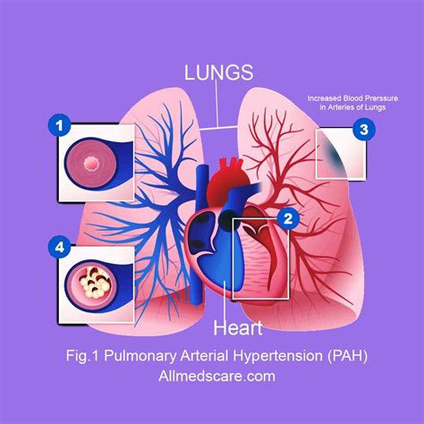 Pulmonary Arterial Hypertension Information, Risks & Treatment