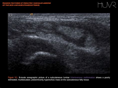 Figure 7 From Imaging Features Of Pediatric Vascular Malformations Of The Skin And Subcutaneous