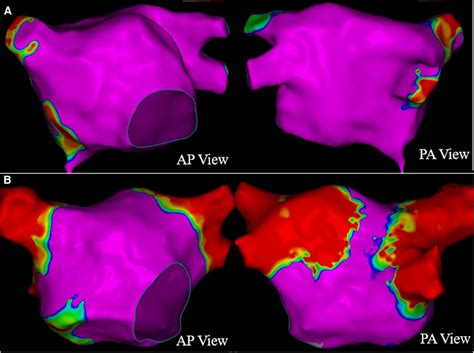 Frontiers Pulsed Field Ablation Of Superior Vena Cava In Paroxysmal