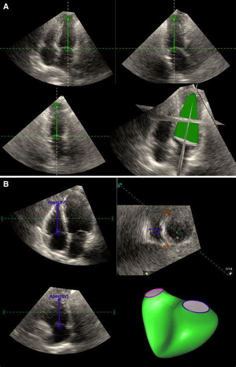 Analysis Of Biventricular Three Dimensional Strain By Tomtec Imaging Download Scientific