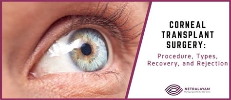 Corneal Transplant Surgery: Procedure, Types, Recovery, and Rejection