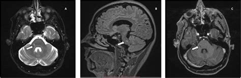 Trigeminal Nerve Involvement In Multiple Sclerosis