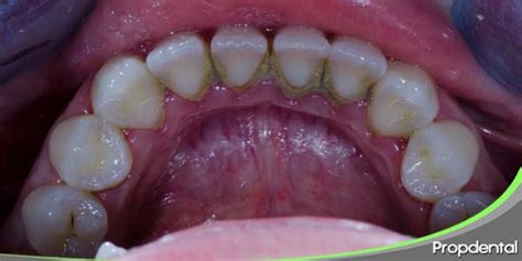 ¿que Es El Absceso Periapical ¿tienes Un Dolor Es Profundo Y Flemón