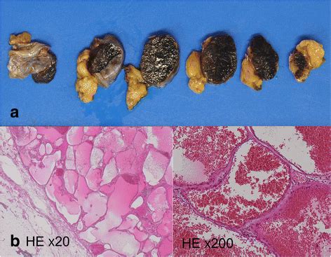 Cavernous Hemangioma In The Thymus A Case Report Surgical Case Reports