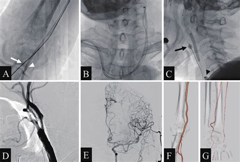 Angiography During Carotid Artery Stenting A An 8 Fr Balloon Guide Download Scientific