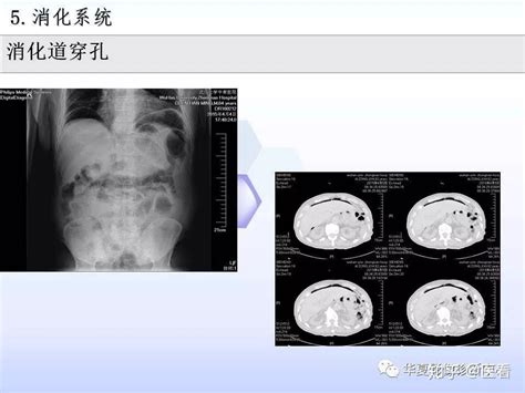 服！放射科主任总结的5大类医学影像危急值（建议收藏） 知乎