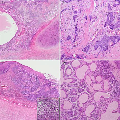 Squamous Cell Carcinoma Histology Ear