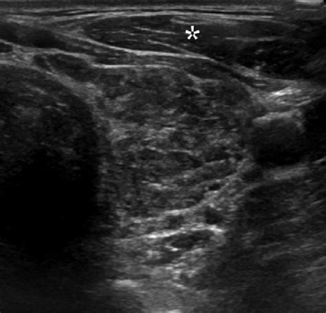 Hypoechogenicity A 35 Year Old Female With Hashimoto Thyroiditis