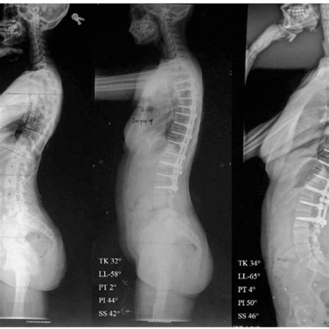 This 14 Year Old Girl Presented With Adolescent Idiopathic Scoliosis Download Scientific