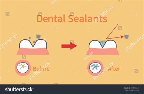 Dental Sealants: Over 173 Royalty-Free Licensable Stock Vectors ...