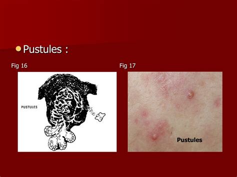 Ppt Acne Disorders Of Sebaceous Gland Powerpoint Presentation Free Download Id9577232