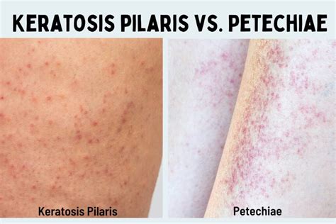 Petechiae Vs Keratosis Pilaris What Is The Difference