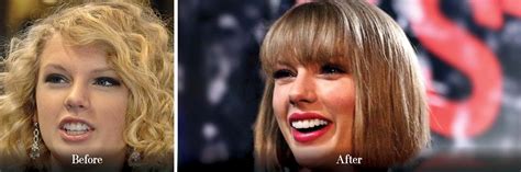 Taylor Swift Before And After Veneers