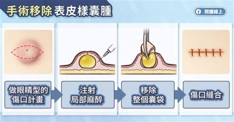 臉上凸起「一粒」竟不是痘痘！醫揭「表皮樣囊腫」特徵、症狀與治療uho優活健康網