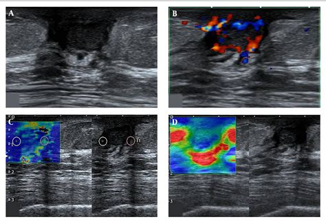 Idiopathic Granulomatous Lobular Mastitis In A Male Breast A Case