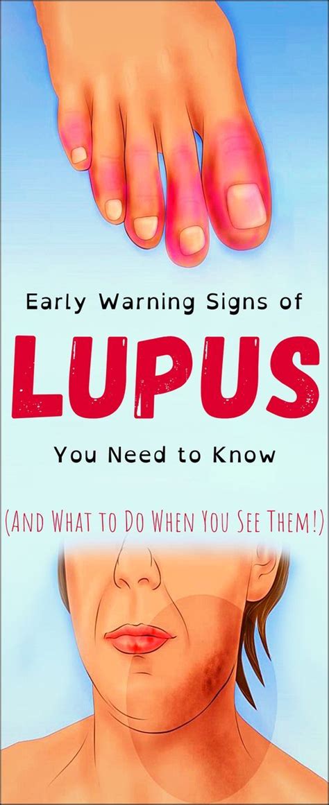 13 Early Warning Signs Of Lupus You Need To Know And What To Do The