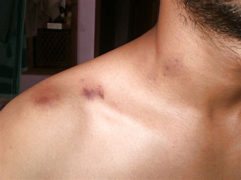 Love Bites Porn Pictures XXX Photos Sex Images PICTOA