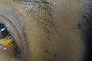 Yellowing Under The Eyes - Infoupdate.org